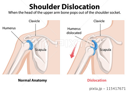 Shoulder Dislocation Anatomy Illustration 115417671