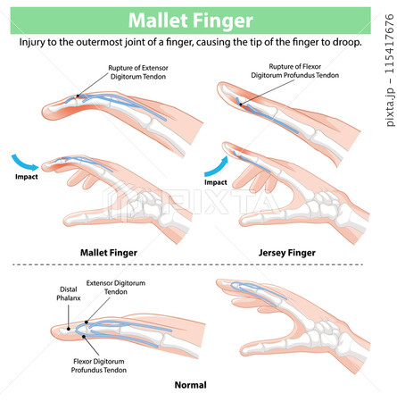 Mallet Finger Injury Illustration 115417676