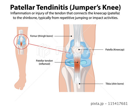 Patellar Tendinitis Illustration 115417681