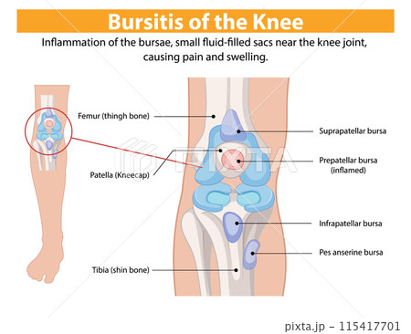 Bursitis of the Knee Illustration Bursitis of the Knee Illustration 115417701