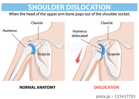 Shoulder Dislocation Anatomy Illustration Shoulder Dislocation Anatomy Illustration 115417703