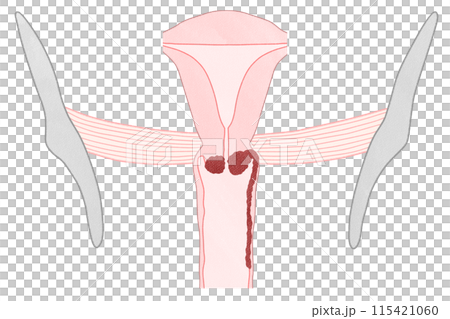 Cervical cancer stage IIIA (stage 3A) - Easy-to-understand illustration 115421060