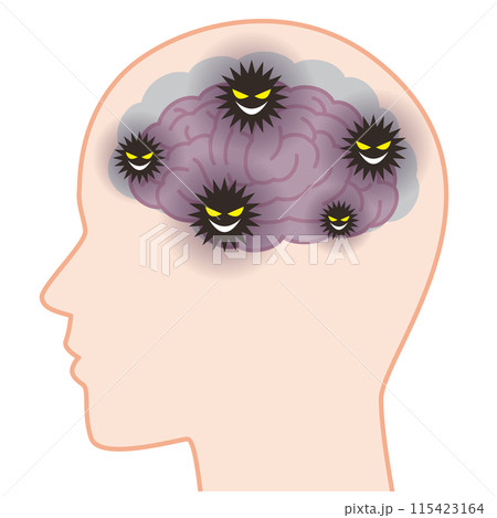 脳内に溜まったゴミによって萎縮した認知症の脳 115423164