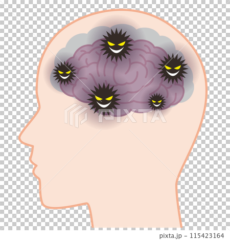 脳内に溜まったゴミによって萎縮した認知症の脳 115423164