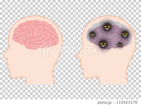 A healthy brain and a brain that has shrunk due to the accumulation of waste A healthy brain and a brain that has shrunk due to the accumulation of waste 115423170