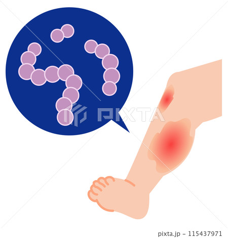 劇症型溶血性レンサ球菌感染症　腫れる足　イラスト 115437971
