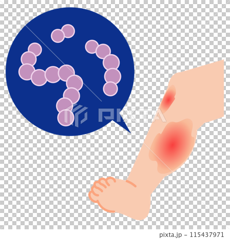 劇症型溶血性レンサ球菌感染症　腫れる足　イラスト 115437971