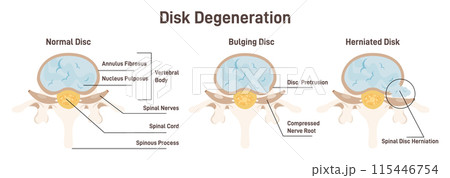 Disc degeneration stages set. flat Spine vertebrae anatomy scheme, healthy lumbar and medical conditions - bulging and herniated disc. Educational medical information. Flat vector illustration 115446754