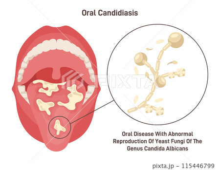 Oral candidiasis. Oral yeast infection of...のイラスト素材 [115446799] - PIXTA