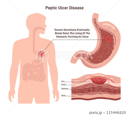 Peptic ulcer disease. Stomach wall with a sore on the lining. Digestive tract organ disorder. Flat vector illustration. Peptic ulcer disease. Stomach wall with a sore on the lining. Digestive tract organ disorder. Flat vector illustration. 115446820