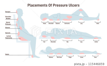 Pressure ulcers placements. Pressure sores areas on human body parts. Bedsore positions. Flat vector illustration. Pressure ulcers placements. Pressure sores areas on human body parts. Bedsore positions. Flat vector illustration. 115446859