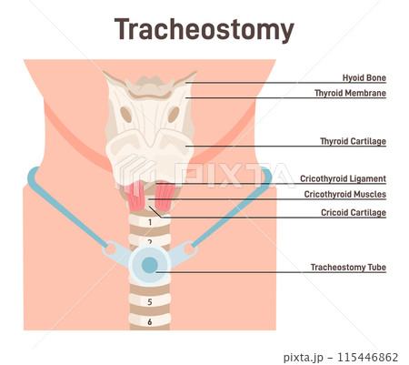 Tracheostomy. Tracheal surgery neutralise airway obstruction. Plastic cannula with inflatable cuff. Trachea anatomy. Flat vector illustration Tracheostomy. Tracheal surgery neutralise airway obstruction. Plastic cannula with inflatable cuff. Trachea anatomy. Flat vector illustration 115446862