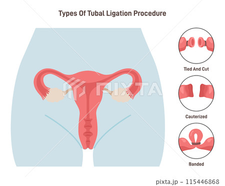 Tubal ligation surgery. Permanent birth control procedure types. Tubes blockage prevent egg fertilization. Flat vector illustration Tubal ligation surgery. Permanent birth control procedure types. Tubes blockage prevent egg fertilization. Flat vector illustration 115446868