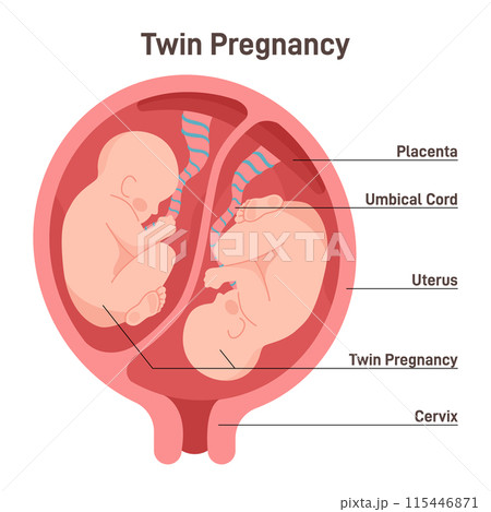 Twin pregnancy. Anatomy of womb with twin fetuses. Dizygotic twins placement. Flat vector illustration 115446871