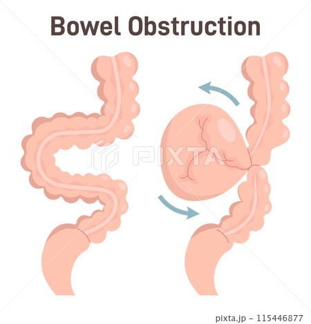 Bowel obstruction or volvulus. Loop of intestine twists around itself. Human digestive system disease. Abdominal internal organs. Flat vector illustration 115446877