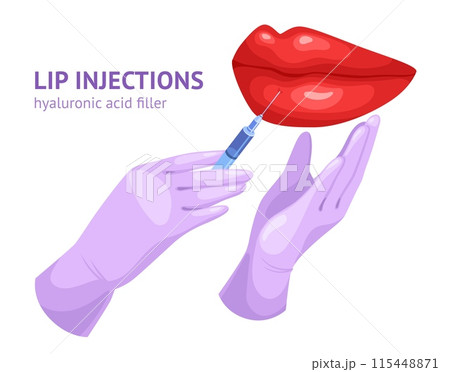 Lip injection. Lips fillers injectables, botox syringe injecting needle injections for sexy woman face plastic volume augmentation in beauty salon, ingenious vector illustration 115448871