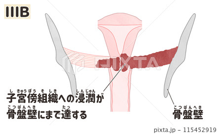 子宮頸がんステージⅢB(3B期) わかりやすい日本語図解イラスト 子宮頸がんステージⅢB(3B期) わかりやすい日本語図解イラスト 115452919