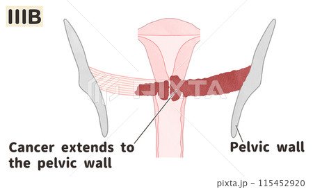 子宮頸がんステージⅢB(3B期) わかりやすい英語図解イラスト 子宮頸がんステージⅢB(3B期) わかりやすい英語図解イラスト 115452920