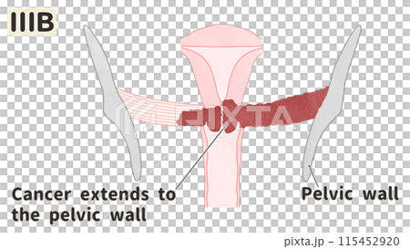 子宮頸がんステージⅢB(3B期) わかりやすい英語図解イラスト 子宮頸がんステージⅢB(3B期) わかりやすい英語図解イラスト 115452920