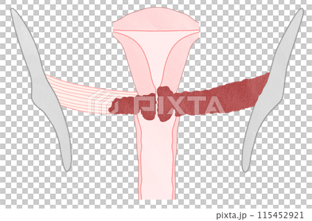 Cervical cancer stage IIIB (stage 3B) - Easy-to-understand illustration 115452921