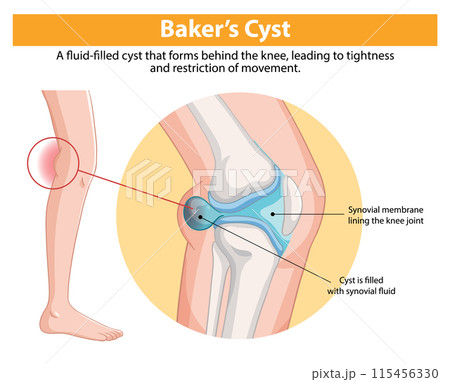 Baker's Cyst in the Knee 115456330