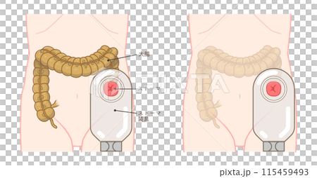 Colostomy, stoma, colon, illustration Colostomy, stoma, colon, illustration 115459493