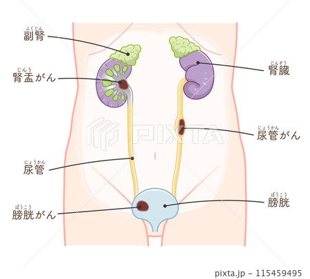 腎臓、尿管、膀胱、腎臓がん、腎盂がん、癌、尿管がん、膀胱がん、illustration、イラスト 115459495
