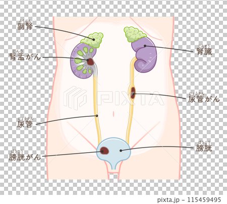 Kidney, ureter, bladder, kidney cancer, renal pelvis cancer, cancer, ureter cancer, bladder cancer, illustration 115459495
