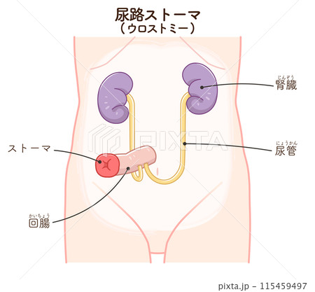 尿路ストーマ、ストーマ、ウロストミー、urostomy、オストメイト、大腸、小腸、膀胱、イラスト、i 115459497