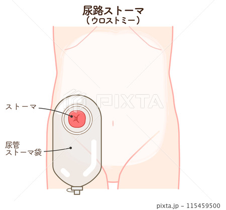 尿路ストーマ、ストーマ、ウロストミー、urostomy、オストメイト、大腸、小腸、膀胱、イラスト、i 尿路ストーマ、ストーマ、ウロストミー、urostomy、オストメイト、大腸、小腸、膀胱、イラスト、i 115459500