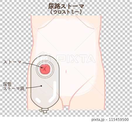 尿路ストーマ、ストーマ、ウロストミー、urostomy、オストメイト、大腸、小腸、膀胱、イラスト、i 尿路ストーマ、ストーマ、ウロストミー、urostomy、オストメイト、大腸、小腸、膀胱、イラスト、i 115459500