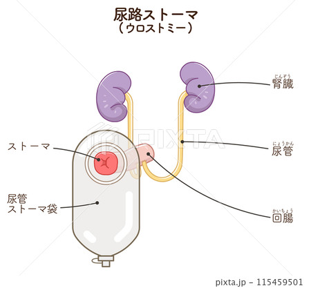 尿路ストーマ、ストーマ、ウロストミー、urostomy、オストメイト、大腸、小腸、膀胱、イラスト、i 尿路ストーマ、ストーマ、ウロストミー、urostomy、オストメイト、大腸、小腸、膀胱、イラスト、i 115459501