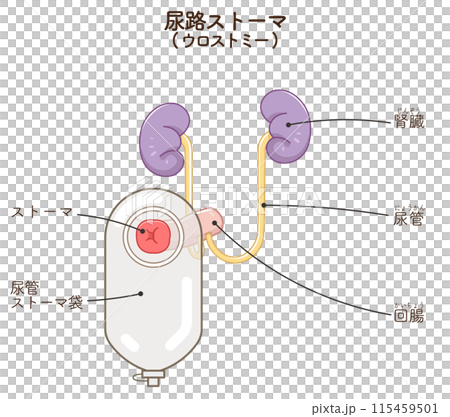 尿路ストーマ、ストーマ、ウロストミー、urostomy、オストメイト、大腸、小腸、膀胱、イラスト、i 尿路ストーマ、ストーマ、ウロストミー、urostomy、オストメイト、大腸、小腸、膀胱、イラスト、i 115459501