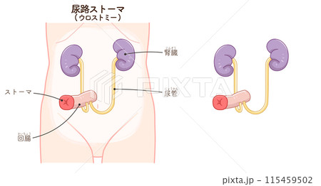 尿路ストーマ、ストーマ、ウロストミー、urostomy、オストメイト、大腸、小腸、膀胱、イラスト、i 115459502