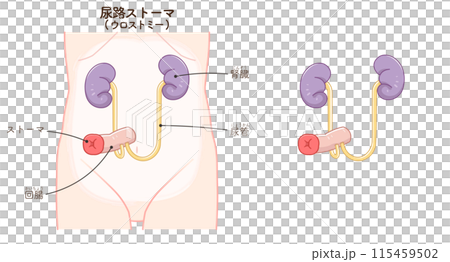 尿路ストーマ、ストーマ、ウロストミー、urostomy、オストメイト、大腸、小腸、膀胱、イラスト、i 115459502