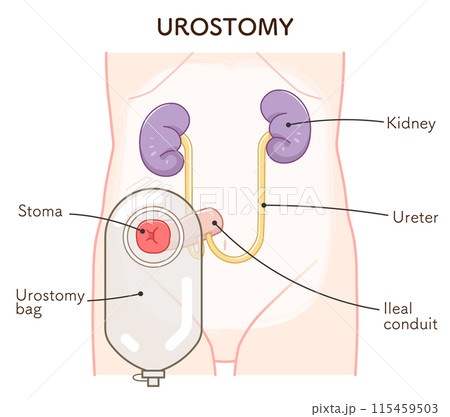 尿路ストーマ、ストーマ、ウロストミー、urostomy、オストメイト、大腸、小腸、膀胱、イラスト、i 115459503