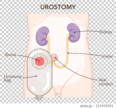 尿路ストーマ、ストーマ、ウロストミー、urostomy、オストメイト、大腸、小腸、膀胱、イラスト、i 115459503