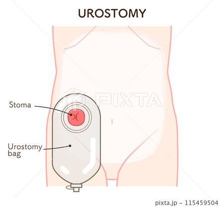 尿路ストーマ、ストーマ、ウロストミー、urostomy、オストメイト、大腸、小腸、膀胱、イラスト、i 尿路ストーマ、ストーマ、ウロストミー、urostomy、オストメイト、大腸、小腸、膀胱、イラスト、i 115459504
