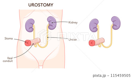 尿路ストーマ、ストーマ、ウロストミー、urostomy、オストメイト、大腸、小腸、膀胱、イラスト、i 尿路ストーマ、ストーマ、ウロストミー、urostomy、オストメイト、大腸、小腸、膀胱、イラスト、i 115459505