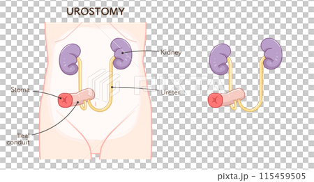 尿路ストーマ、ストーマ、ウロストミー、urostomy、オストメイト、大腸、小腸、膀胱、イラスト、i 尿路ストーマ、ストーマ、ウロストミー、urostomy、オストメイト、大腸、小腸、膀胱、イラスト、i 115459505