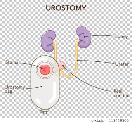 Urinary stoma, stoma, urostomy, ostomate, large intestine, small intestine, bladder, illustration, i Urinary stoma, stoma, urostomy, ostomate, large intestine, small intestine, bladder, illustration, i 115459506