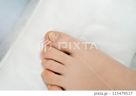 A womans feet after appling a titanium thread to a toenail.  115479517