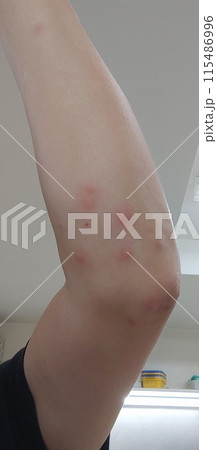 虫刺され 虫刺され 115486996
