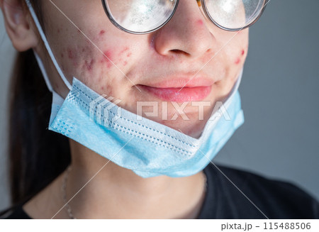 Close up of young Asian woman open her mask and showing acne problem occur on her skin caused of wearing mask for longtime. Close up of young Asian woman open her mask and showing acne problem occur on her skin caused of wearing mask for longtime. 115488506