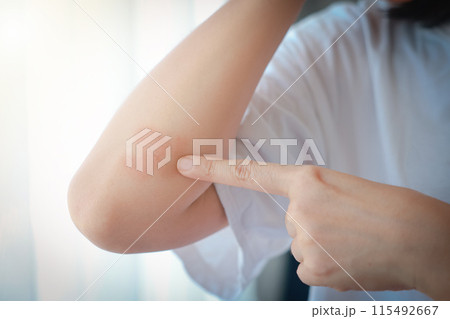 Close-up of skin Asian woman with acute psoriasis on her elbows. autoimmune incurable dermatological skin disease. A large red, inflamed, flaky rash on the elbows. skin by psoriatic arthritis. Close-up of skin Asian woman with acute psoriasis on her elbows. autoimmune incurable dermatological skin disease. A large red, inflamed, flaky rash on the elbows. skin by psoriatic arthritis. 115492667