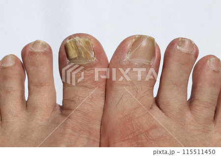 爪水虫の足 爪水虫の足 115511450