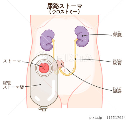 尿路ストーマ、ストーマ、ウロストミー、urostomy、オストメイト、大腸、小腸、膀胱、イラスト 115517624