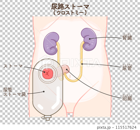尿路ストーマ、ストーマ、ウロストミー、urostomy、オストメイト、大腸、小腸、膀胱、イラスト 115517624