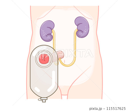 尿路ストーマ、ストーマ、ウロストミー、urostomy、オストメイト、大腸、小腸、膀胱、イラスト 115517625