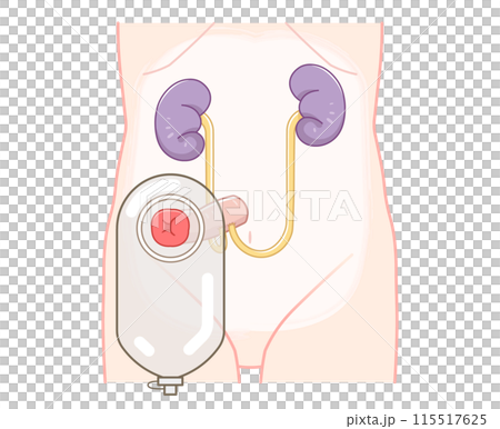 尿路ストーマ、ストーマ、ウロストミー、urostomy、オストメイト、大腸、小腸、膀胱、イラスト 115517625